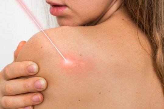 Depilación láser segura y efectiva en zonas con lunares o verrugas Depilación láser segura y efectiva en zonas con lunares o verrugas