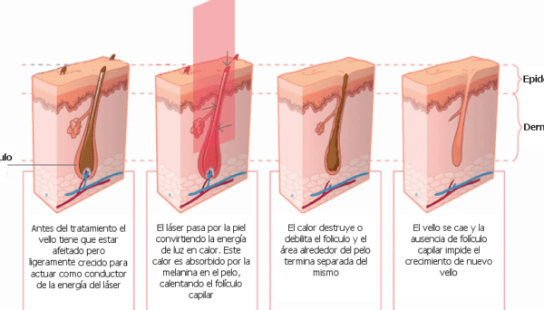 Duración del efecto de la depilación láser según el tipo de vello Duración del efecto de la depilación láser según el tipo de vello