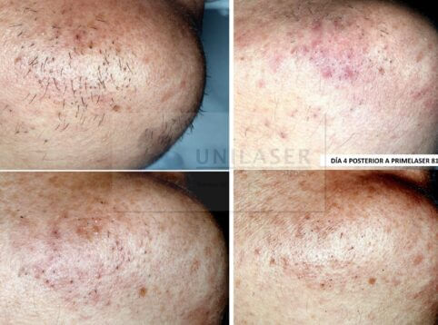 ¿Es adecuada la depiladora láser para el vello grueso o denso?