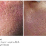 Seguridad de la depiladora láser en cicatrices o marcas de acné