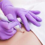 Uso de depiladora láser en áreas con lunares o verrugas: ¿Es seguro?